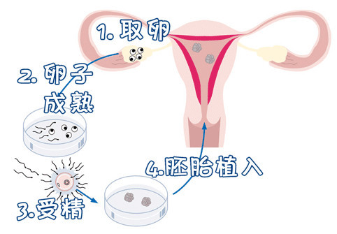 无精症